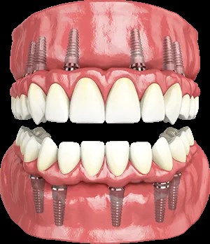 Full Arch Dental Implants in Portland, MI